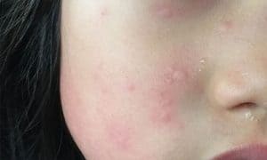 Da nhạy cảm cực “đỏng đảnh”