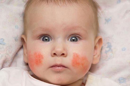 Chàm sữa ở giai đoạn căng da, khô ửng đỏ, không chảy dịch, không mụn