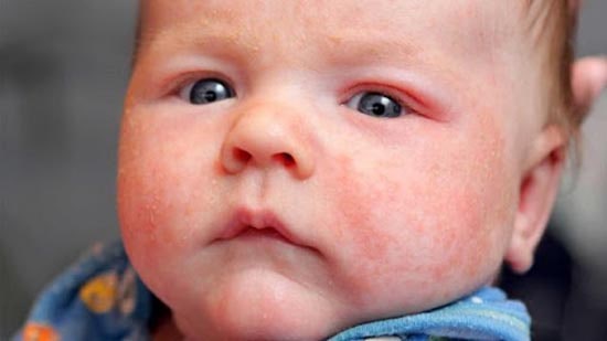 Giai đoạn: Xuất hiện chàm sừng hóa, khô da, bong tróc