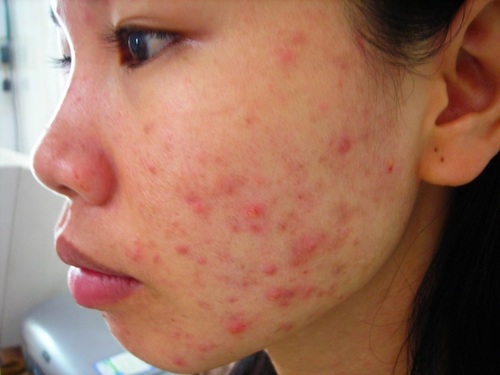 Mọc nhiều mụn khiến da bị yếu và nhạy cảm hơn