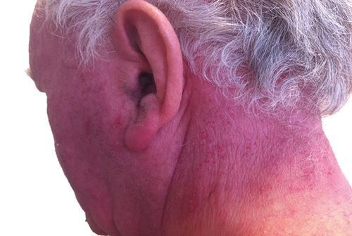 Người bị tình trạng Photodermatoses