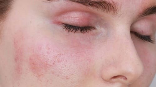Cảm giác châm chích gây cảm giác khó chịu