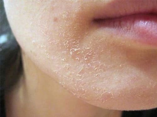 Bong da, tróc vảy cũng là dấu hiệu của da nhạy cảm