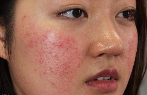 Những người sở hữu da nhạy cảm dễ bị mụn “tấn công”