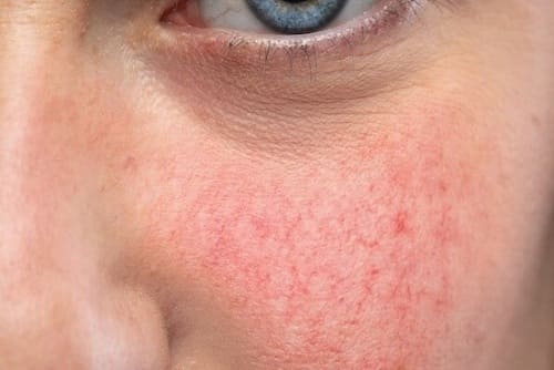 Da nhạy cảm rất mỏng và dễ bị vỡ mao mạch