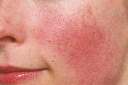 Da dị ứng gây nhiều khó chịu