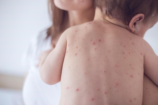 Thủy đậu tiến triển qua 4 giai đoạn với những dấu hiệu khác nhau