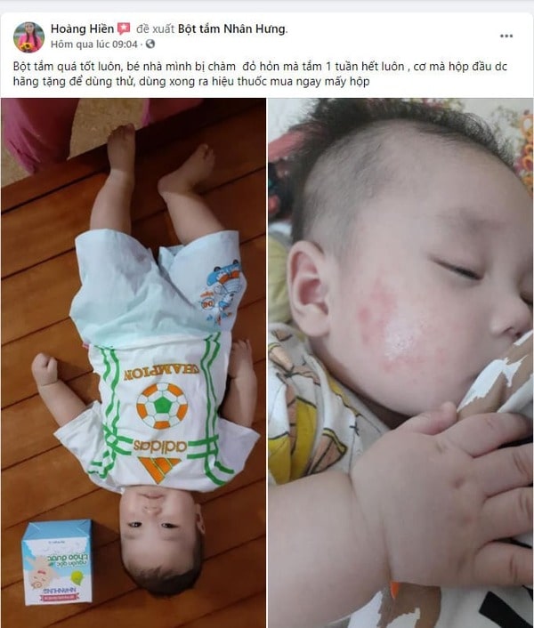 Hàng loạt mẹ bỉm “khoe” thành tích trị chàm sữa cho con “bất bại”