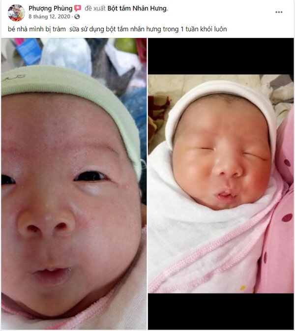 Hàng loạt mẹ bỉm “khoe” thành tích trị chàm sữa cho con “bất bại”