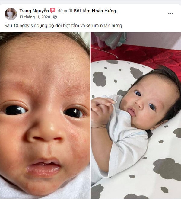 Hàng loạt mẹ bỉm “khoe” thành tích trị chàm sữa cho con “bất bại”