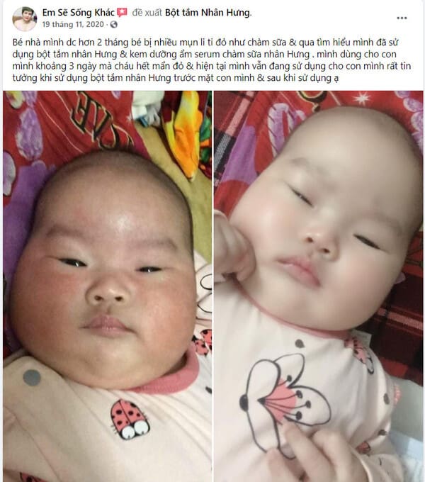 Hàng loạt mẹ bỉm “khoe” thành tích trị chàm sữa cho con “bất bại”