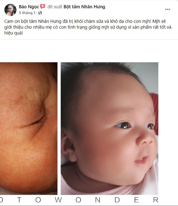Hàng loạt mẹ bỉm “khoe” thành tích trị chàm sữa cho con “bất bại”