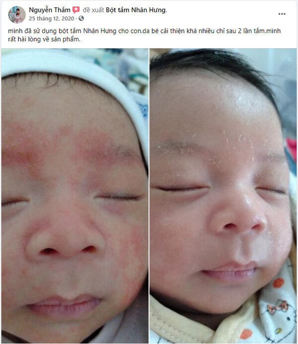 Hàng loạt mẹ bỉm “khoe” thành tích trị chàm sữa cho con “bất bại”