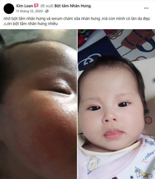 Hàng loạt mẹ bỉm “khoe” thành tích trị chàm sữa cho con “bất bại”