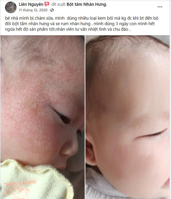 Hàng loạt mẹ bỉm “khoe” thành tích trị chàm sữa cho con “bất bại”