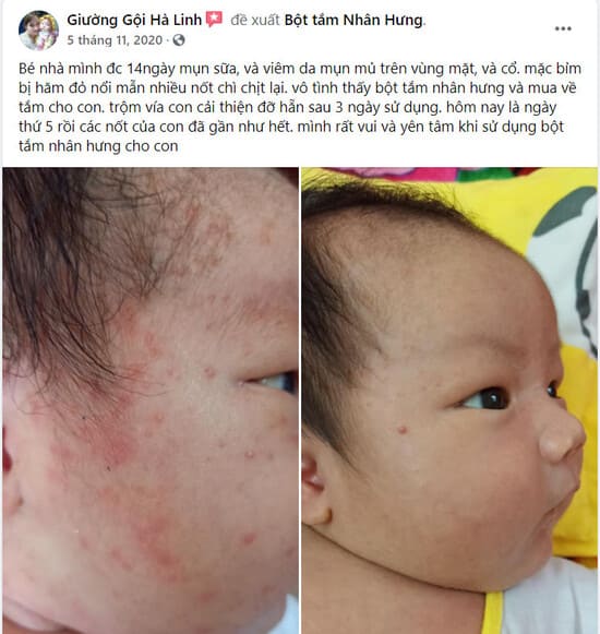 Mụn sữa - Bột tắm Nhân Hưng chữa là hết - 12