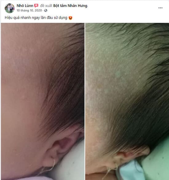 Mụn sữa - Bột tắm Nhân Hưng chữa là hết - 14