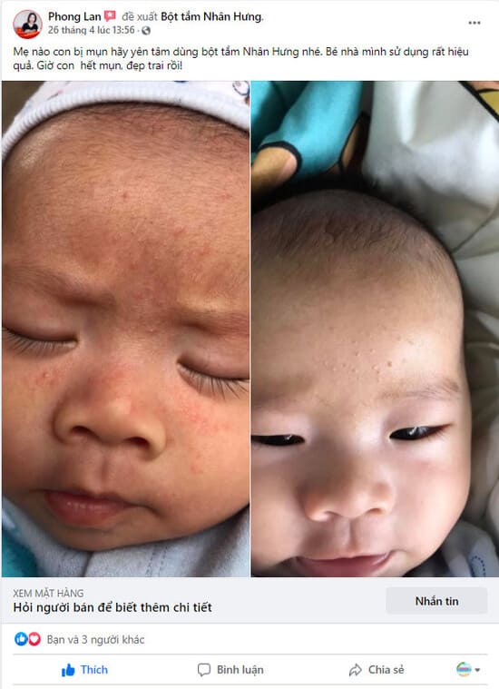 Mụn sữa - Bột tắm Nhân Hưng chữa là hết