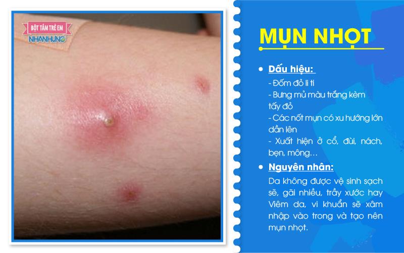 Mụn nhọt dễ gặp ở trẻ trong mùa nắng nóng.