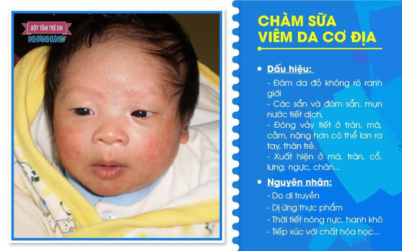 Viêm da cơ địa có thể xảy ra vào mùa hè nóng nực.