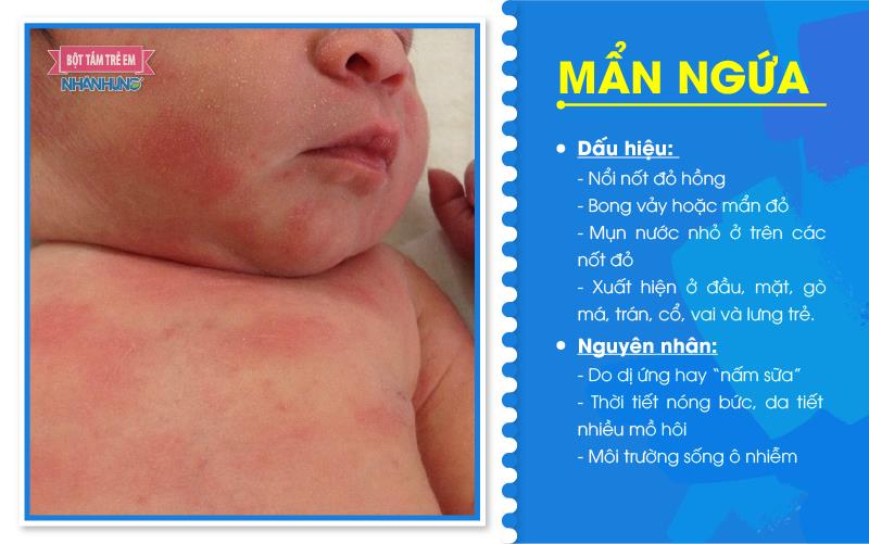 Mẩn ngứa là bệnh phổ biến ở trẻ vào mùa hè.