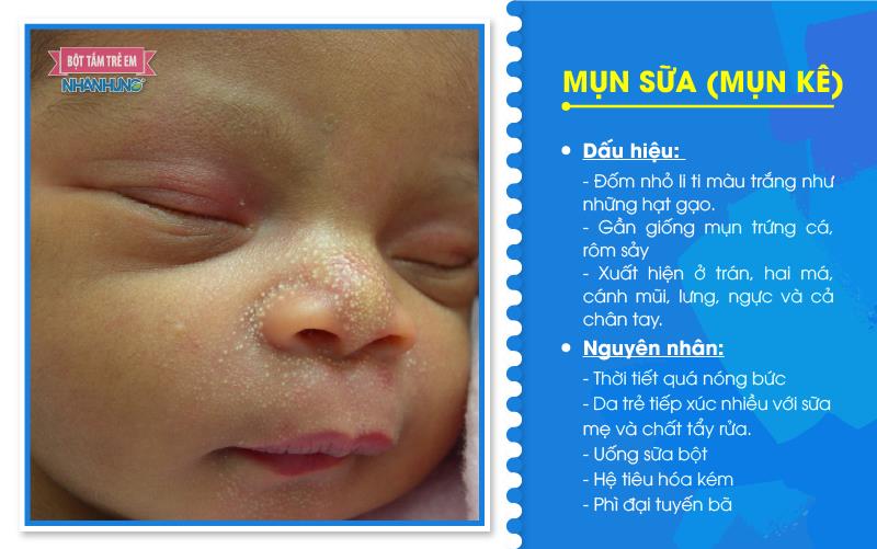 Mụn kê mùa hè khiến trẻ ngứa ngáy và khó chịu.