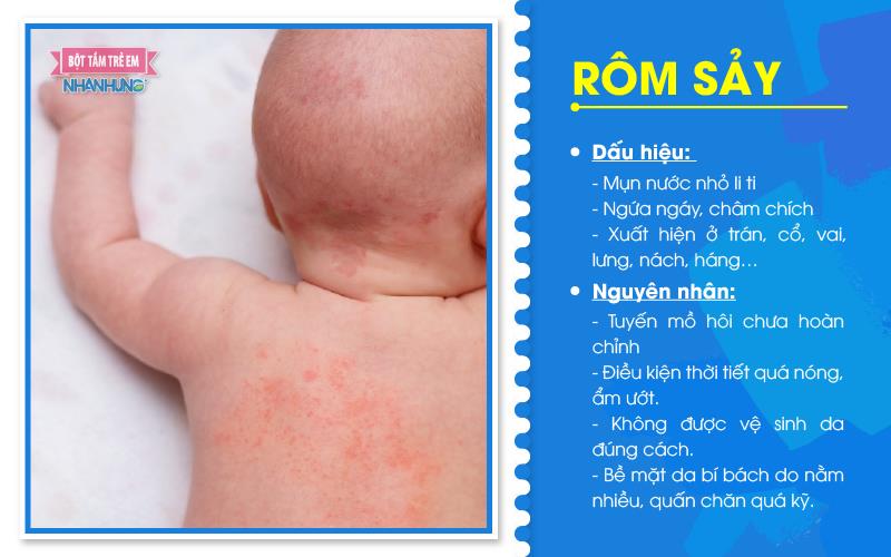 Nhận biết bệnh rôm sảy ở trẻ vào mùa hè.