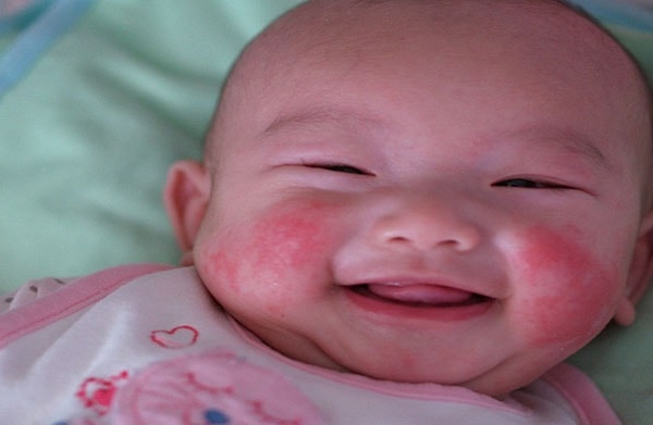Trẻ bị chàm sữa cũng có thể gây dị ứng nổi mụn khắp mặt.