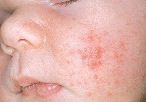 Biểu hiện của mụn sữa ở trẻ là xuất hiện dị ứng nổi mụn khắp mặt.