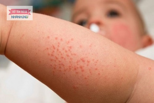 Da bị nổi mẩn đỏ nhưng không ngứa có thể do nhiễm virus siêu vi.