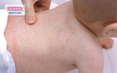 Ban xuất huyết có thể khiến da bị nổi mẩn đỏ nhưng không ngứa.