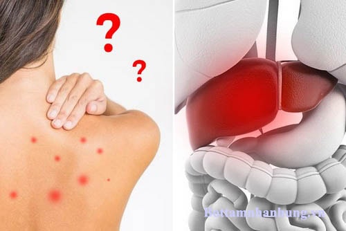 Bệnh lý về gan cũng là nguyên nhân gây ngứa khắp người càng gãi càng ngứa.