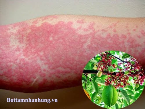 Bài thuốc chữa ngứa ngáy mẩn đỏ từ lá khế.