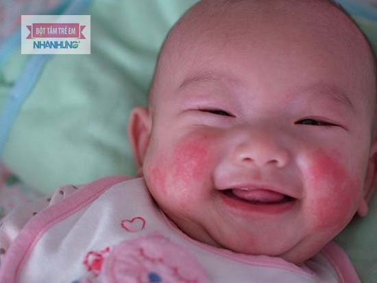 Trẻ có thể mắc chàm sữa quanh năm, kể cả mùa hè nóng ẩm