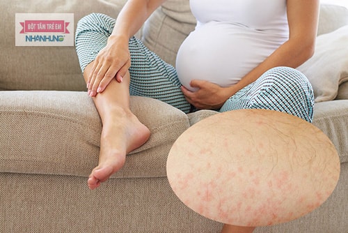Bà bầu bị nổi mẩn ngứa ở chân liên quan đến các vấn đề da liễu.