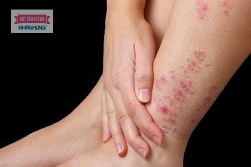 Bà bầu bị nổi mẩn ngứa ở chân cũng là dấu hiệu của một số căn bệnh phiền toái.