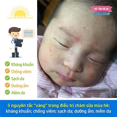 5 nguyên tắc “vàng” trong điều trị chàm sữa mùa hè.