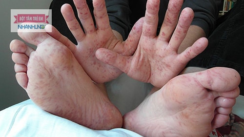 Lòng bàn tay nổi mẩn đỏ ngứa là biểu hiện nhiều bệnh lý ở trẻ.