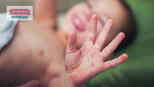 Vẩy nến, Lupus ban đỏ hay bệnh ghẻ có thể khiến long bàn tay nổi mẩn đỏ ngứa.