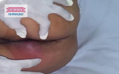Đưa bé bị đỏ quanh hậu môn do apxe đi khám bác sĩ
