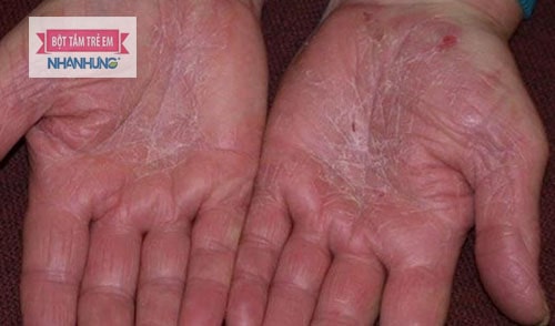 Bệnh á sừng có thể gặp ở nhiều vị trí khác nhau trên cơ thể