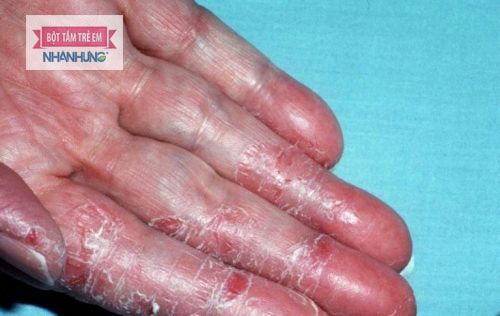 Tuyệt đối không chà sát mạnh lên vùng da bị á sừng