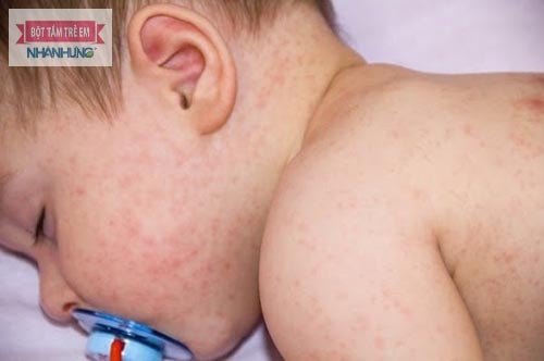 Rôm sảy nếu không điều trị sẽ thường xuyên tái phát