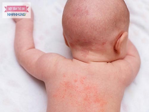 Rôm sảy có lây không? Câu trả lời là không