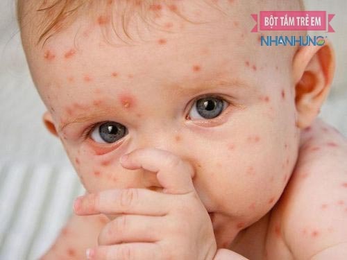 Cần chú trọng chế độ ăn của trẻ bị thủy đậu