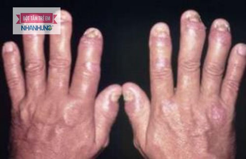 Vẩy nến khiến thẩm mĩ ngoài da bị ảnh hưởng