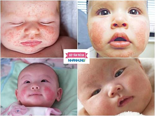 Chàm sữa tiến triển theo năm cấp độ.