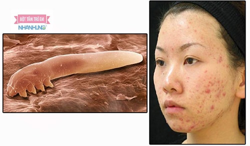 Demodex gây viêm da ở người.