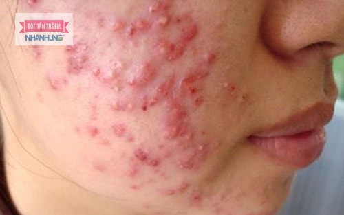 Viêm da dạng trứng cá do Demodex.