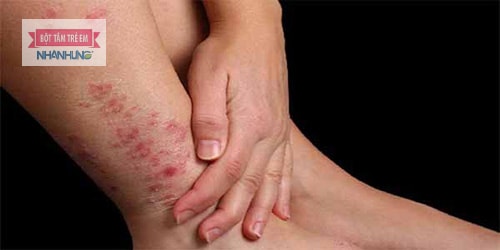 Bệnh viêm da tiếp xúc xảy ra do nhiều nguyên nhân khác nhau.